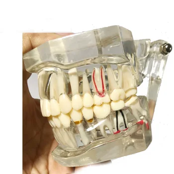 Стоматологическое Исследование, Прозрачная Модель Патологических и Болезнетворных Зубов Взрослого Человека